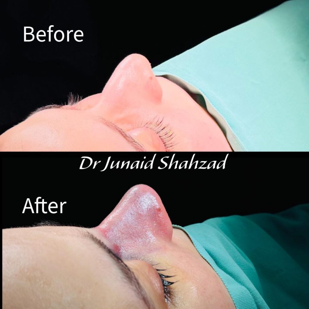 Nose Reshaping Surgery